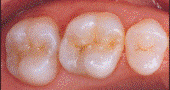 after photo of teeth with clear fillings
