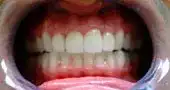 after photo of teeth