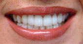 after photo of woman smiling