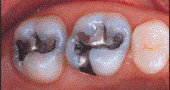 before photo of teeth with silver fillings