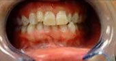 before photo of teeth