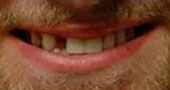before photo of man smiling