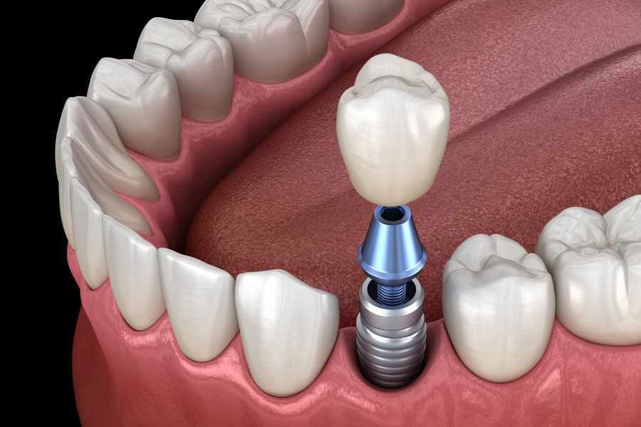 digital model of the dental implant process