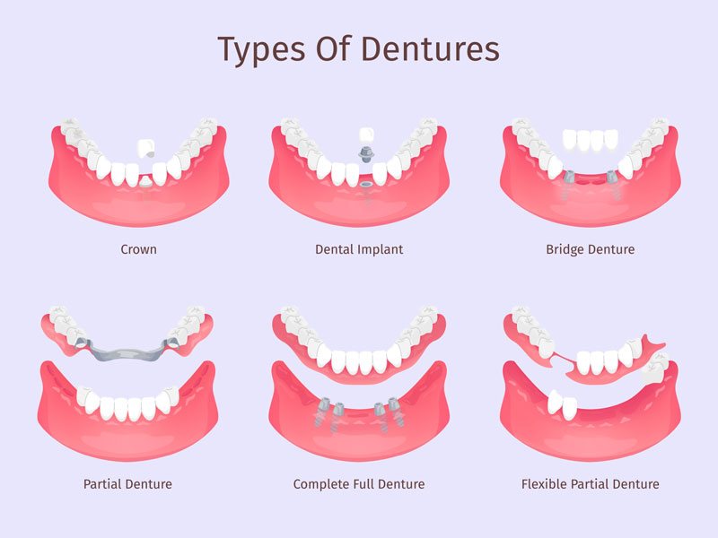 illustration of types of dentures