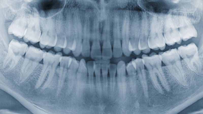 panoramic dental x-ray